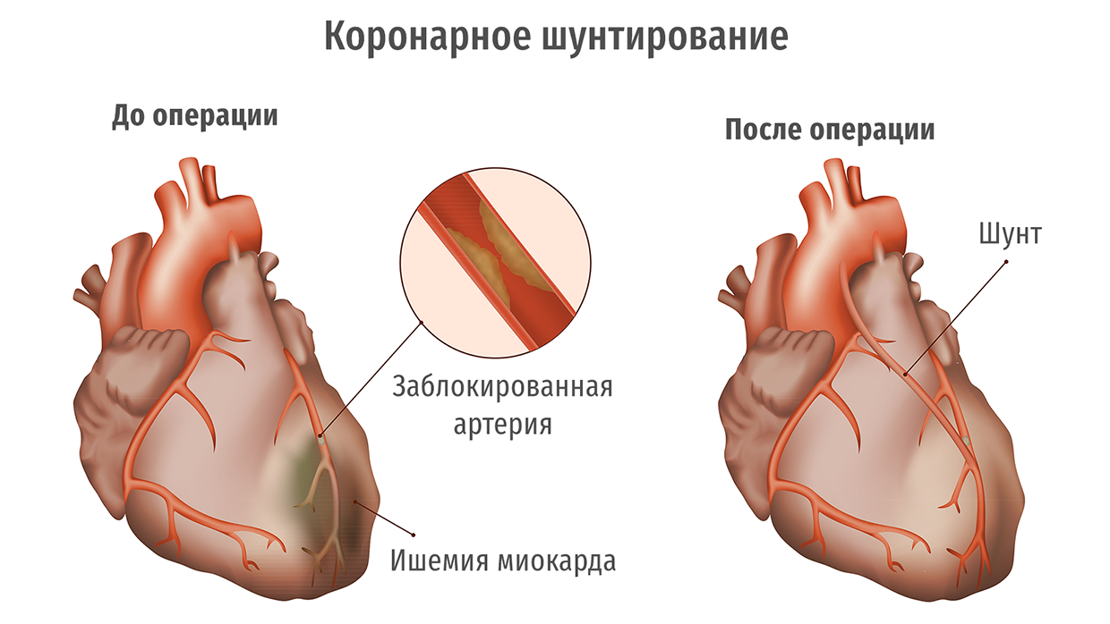 Коронарное шунтирование сосудов сердца